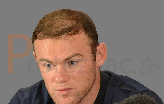 erkek tipi saç dökülmesi